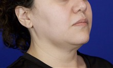 Liposuction Before Photo by Thanapoom Boonipat, MD; Lubbock, TX - Case 51035