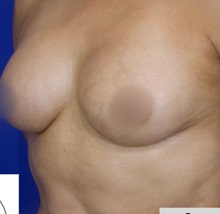 Breast Augmentation After Photo by Thanapoom Boonipat, MD; Lubbock, TX - Case 51071