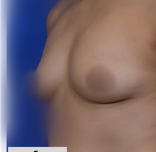 Breast Augmentation Before Photo by Thanapoom Boonipat, MD; Lubbock, TX - Case 51071