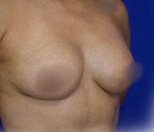 Breast Augmentation After Photo by Thanapoom Boonipat, MD; Lubbock, TX - Case 51071