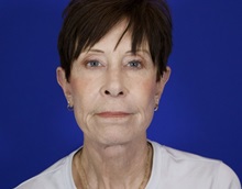 Facelift After Photo by Thanapoom Boonipat, MD; Lubbock, TX - Case 51072