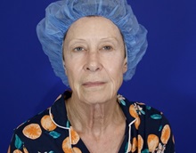 Facelift Before Photo by Thanapoom Boonipat, MD; Lubbock, TX - Case 51072