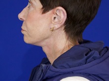 Facelift After Photo by Thanapoom Boonipat, MD; Lubbock, TX - Case 51072