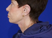 Facelift Before Photo by Thanapoom Boonipat, MD; Lubbock, TX - Case 51072