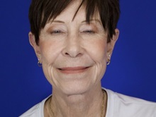 Facelift After Photo by Thanapoom Boonipat, MD; Lubbock, TX - Case 51072
