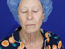 Facelift Before Photo by Thanapoom Boonipat, MD; Lubbock, TX - Case 51072
