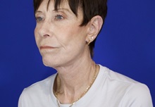 Facelift After Photo by Thanapoom Boonipat, MD; Lubbock, TX - Case 51072