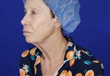 Facelift Before Photo by Thanapoom Boonipat, MD; Lubbock, TX - Case 51072
