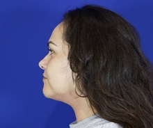 Liposuction After Photo by Thanapoom Boonipat, MD; Lubbock, TX - Case 51283