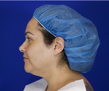 Liposuction Before Photo by Thanapoom Boonipat, MD; Lubbock, TX - Case 51283