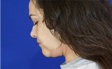 Liposuction After Photo by Thanapoom Boonipat, MD; Lubbock, TX - Case 51283