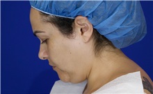 Liposuction Before Photo by Thanapoom Boonipat, MD; Lubbock, TX - Case 51283
