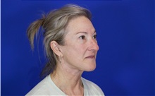 Facelift After Photo by Thanapoom Boonipat, MD; Lubbock, TX - Case 51284
