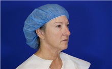 Facelift Before Photo by Thanapoom Boonipat, MD; Lubbock, TX - Case 51284