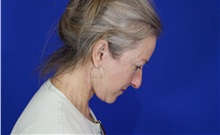 Facelift After Photo by Thanapoom Boonipat, MD; Lubbock, TX - Case 51284