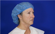 Facelift Before Photo by Thanapoom Boonipat, MD; Lubbock, TX - Case 51284