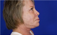 Facelift After Photo by Thanapoom Boonipat, MD; Lubbock, TX - Case 51383
