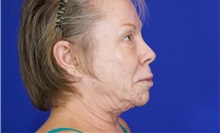 Facelift Before Photo by Thanapoom Boonipat, MD; Lubbock, TX - Case 51383