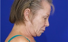 Facelift After Photo by Thanapoom Boonipat, MD; Lubbock, TX - Case 51383