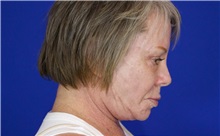 Facelift Before Photo by Thanapoom Boonipat, MD; Lubbock, TX - Case 51383