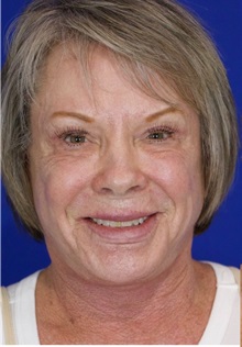 Facelift After Photo by Thanapoom Boonipat, MD; Lubbock, TX - Case 51383