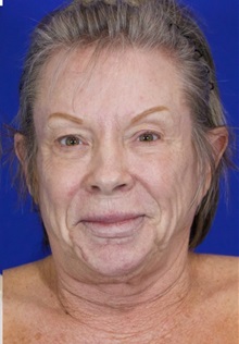 Facelift Before Photo by Thanapoom Boonipat, MD; Lubbock, TX - Case 51383