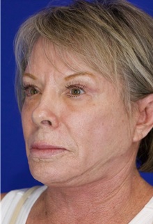 Facelift After Photo by Thanapoom Boonipat, MD; Lubbock, TX - Case 51383
