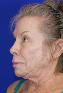Facelift Before Photo by Thanapoom Boonipat, MD; Lubbock, TX - Case 51383