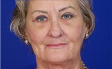Eyelid Surgery After Photo by Thanapoom Boonipat, MD; Lubbock, TX - Case 51387
