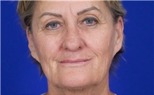 Eyelid Surgery Before Photo by Thanapoom Boonipat, MD; Lubbock, TX - Case 51387