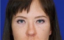 Eyelid Surgery After Photo by Thanapoom Boonipat, MD; Lubbock, TX - Case 51391