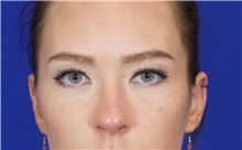 Eyelid Surgery Before Photo by Thanapoom Boonipat, MD; Lubbock, TX - Case 51391