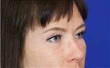 Eyelid Surgery After Photo by Thanapoom Boonipat, MD; Lubbock, TX - Case 51391