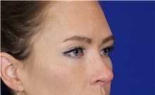 Eyelid Surgery Before Photo by Thanapoom Boonipat, MD; Lubbock, TX - Case 51391