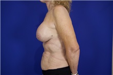 Eyelid Surgery After Photo by Thanapoom Boonipat, MD; Lubbock, TX - Case 51391