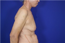 Eyelid Surgery Before Photo by Thanapoom Boonipat, MD; Lubbock, TX - Case 51391