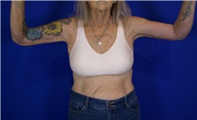 Arm Lift After Photo by Thanapoom Boonipat, MD; Lubbock, TX - Case 51388