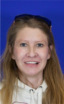 Facelift After Photo by Thanapoom Boonipat, MD; Lubbock, TX - Case 51422