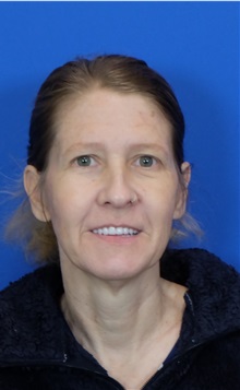 Facelift Before Photo by Thanapoom Boonipat, MD; Lubbock, TX - Case 51422