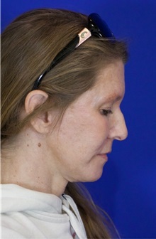 Facelift After Photo by Thanapoom Boonipat, MD; Lubbock, TX - Case 51422