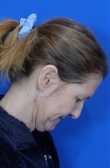 Facelift Before Photo by Thanapoom Boonipat, MD; Lubbock, TX - Case 51422