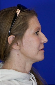 Facelift After Photo by Thanapoom Boonipat, MD; Lubbock, TX - Case 51422