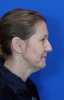 Facelift Before Photo by Thanapoom Boonipat, MD; Lubbock, TX - Case 51422