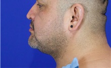 Cheek Reduction After Photo by Thanapoom Boonipat, MD; Lubbock, TX - Case 51421