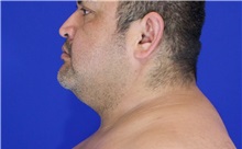 Cheek Reduction Before Photo by Thanapoom Boonipat, MD; Lubbock, TX - Case 51421