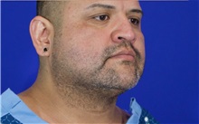 Cheek Reduction After Photo by Thanapoom Boonipat, MD; Lubbock, TX - Case 51421