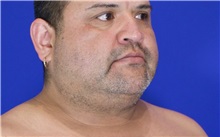 Cheek Reduction Before Photo by Thanapoom Boonipat, MD; Lubbock, TX - Case 51421