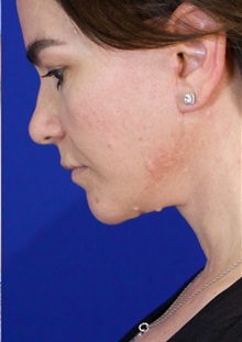 Facelift After Photo by Thanapoom Boonipat, MD; Lubbock, TX - Case 51424