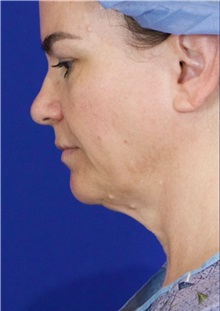 Facelift Before Photo by Thanapoom Boonipat, MD; Lubbock, TX - Case 51424