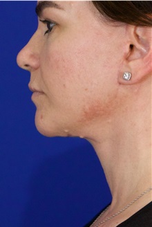 Facelift After Photo by Thanapoom Boonipat, MD; Lubbock, TX - Case 51424